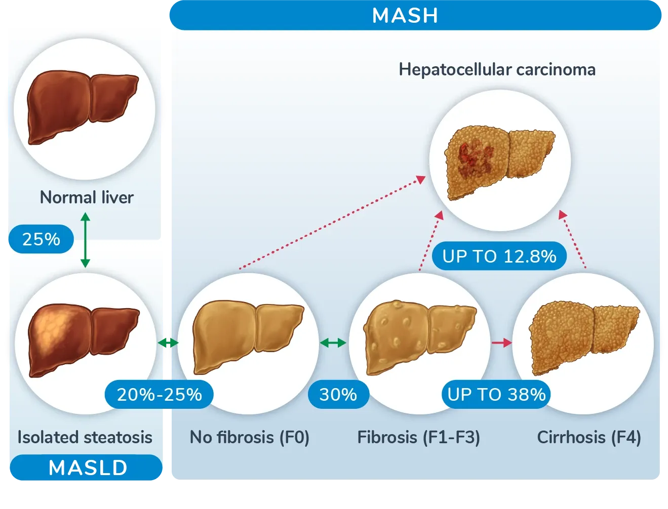 NASH-NAFLD - Nonalcoholic Steatohepatitis and fatty liver disease